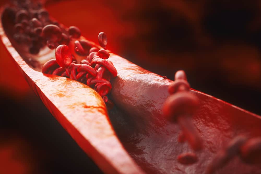 All You Need To Know About Atherosclerosis