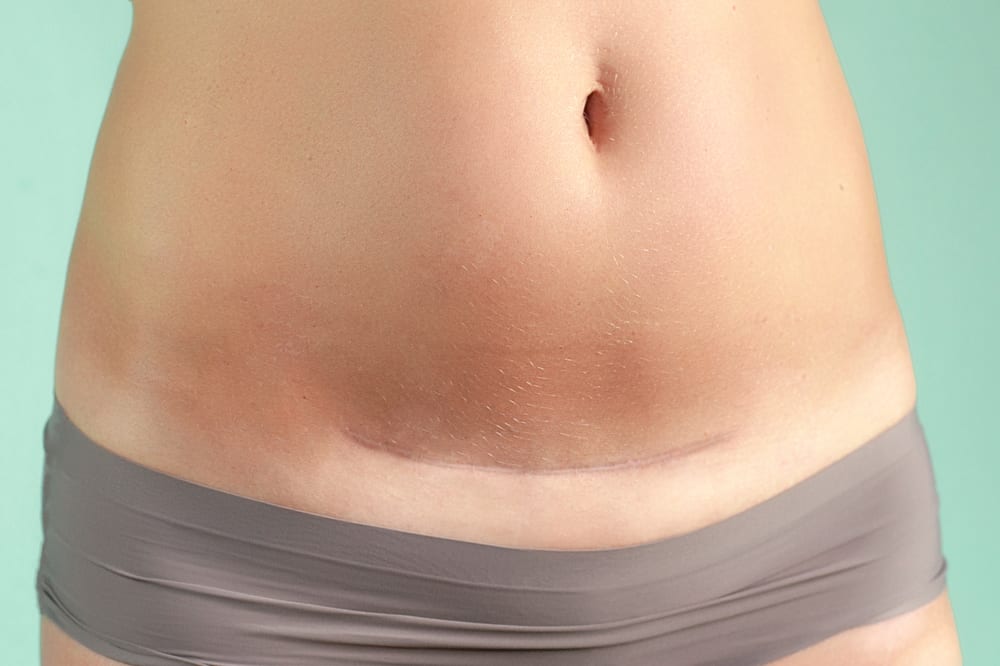 Postpartum Recovery Tips: What to Do After a C-Section