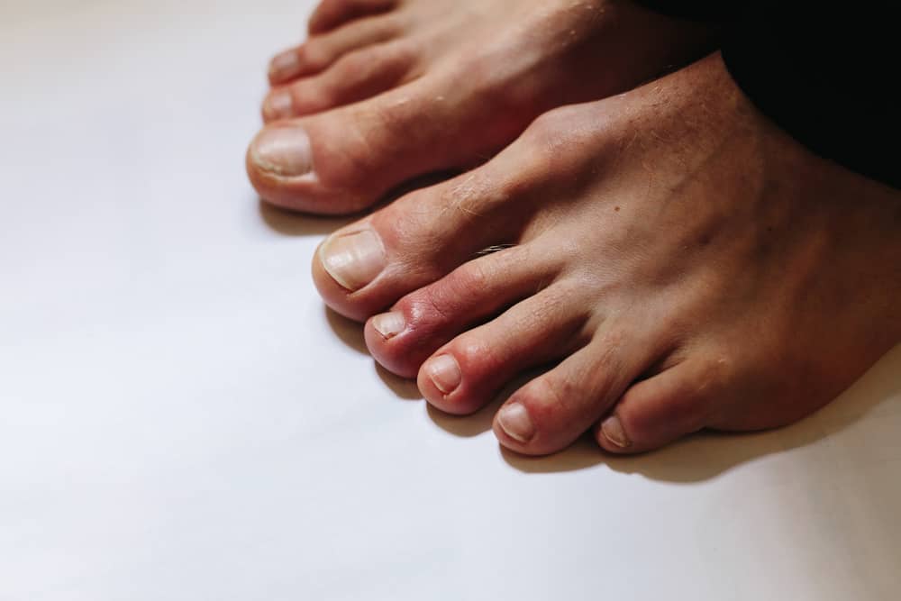 Are 'COVID Toes' The Newest COVID-19 Symptom?