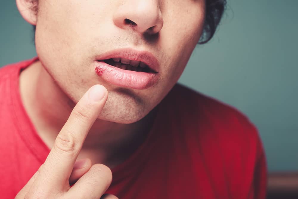 Types of Oral STDS and How to Recognize Them