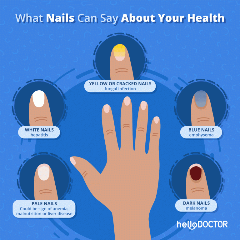 Fingernails and Health Conditions What's the Connection? Hello Doctor
