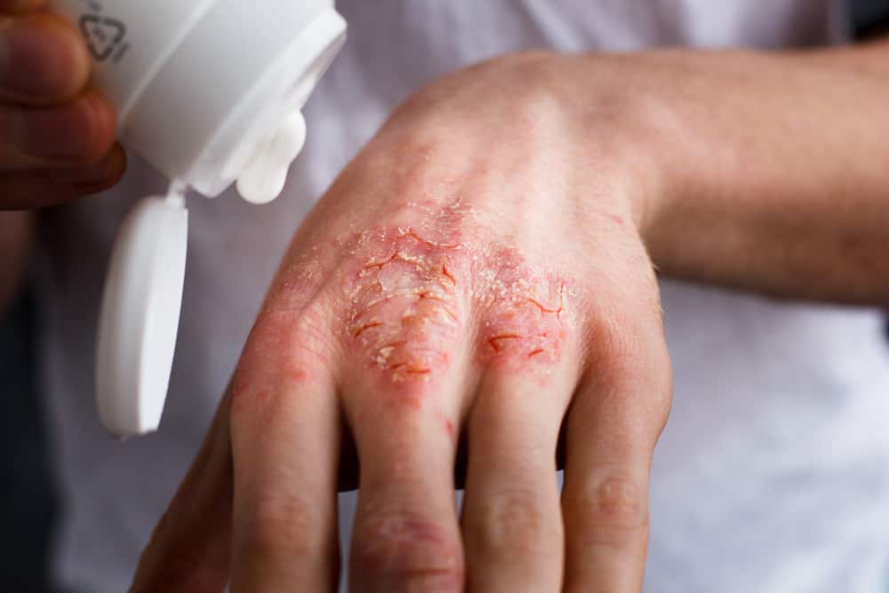 The Best Treatment and Home Remedies for Eczema