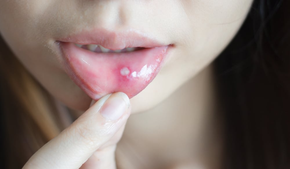 How to Prevent Singaw: What to Do and Not Do to Prevent Mouth Sores