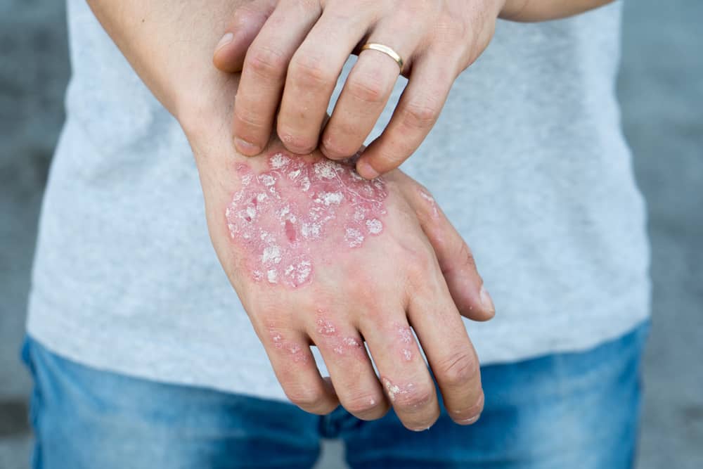 All You Need To Know About Psoriasis