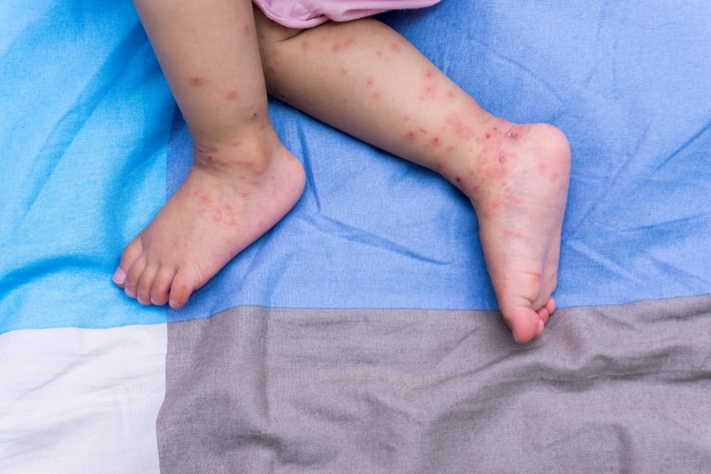 Hand, Foot, and Mouth Disease: What Parents Need to Know