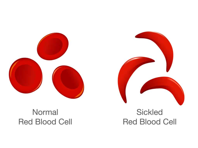 Sickle Cell Anemia What Happens When Red Blood Cells Are SickleShaped