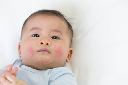 7 Common Baby Skin Rashes and How to Treat Them at Home