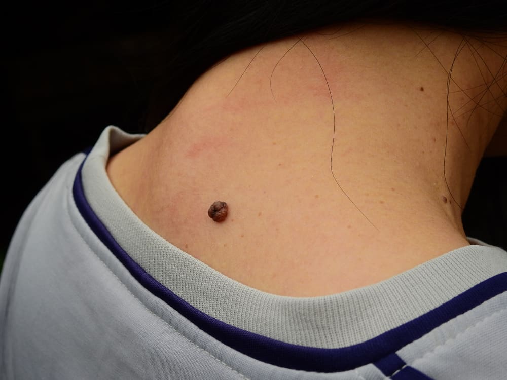 Buhay Na Nunal: Is It Normal Or Should I Worry About It?