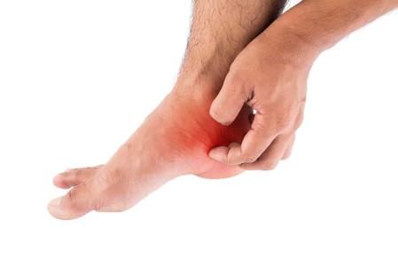 How To Treat Athlete's Foot: Important Tips To Remember