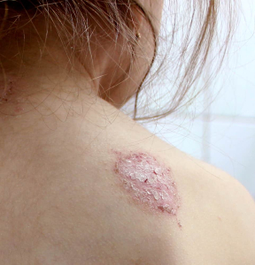 What Triggers Eczema Flare-ups?