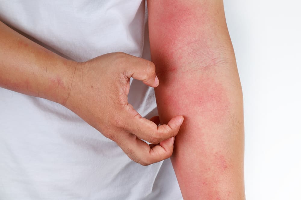 Types of Psoriasis: What You Need To Know