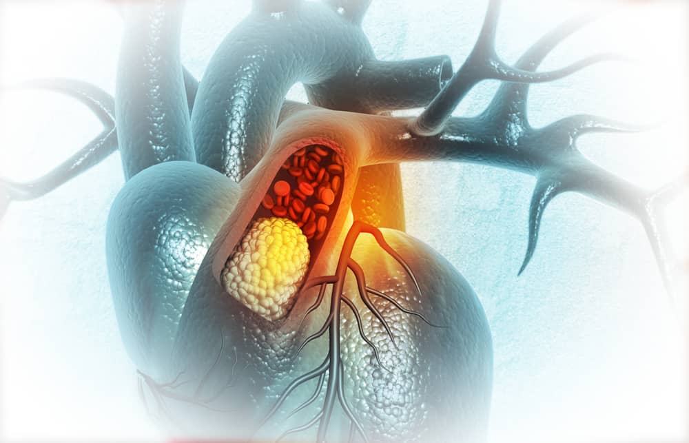 Atherosclerosis of Aorta: Causes and Symptoms