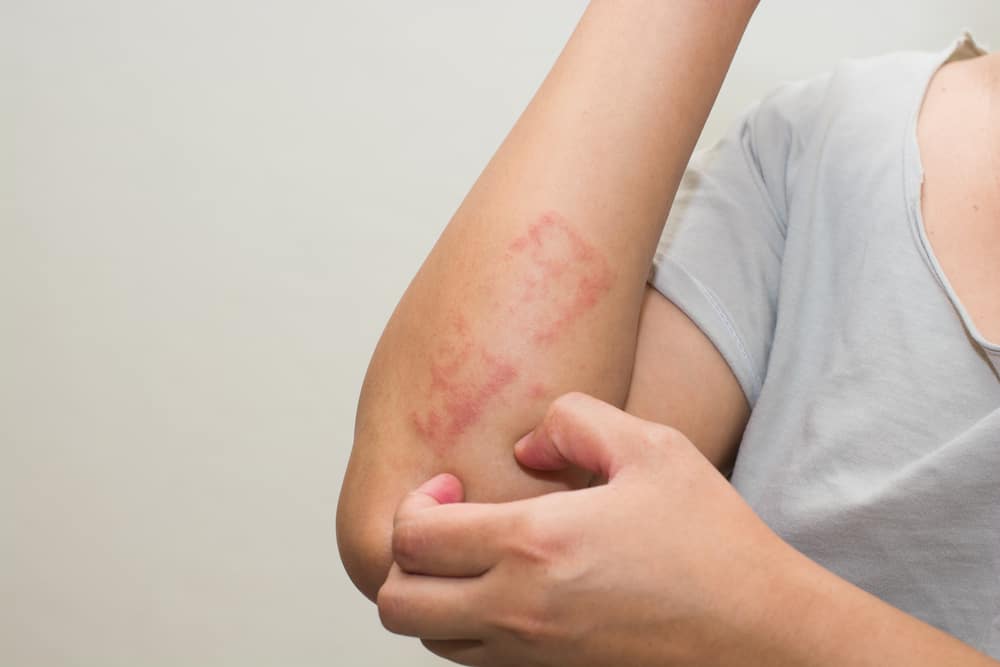 Eczema: Symptoms and Treatment for This Type of Dermatitis