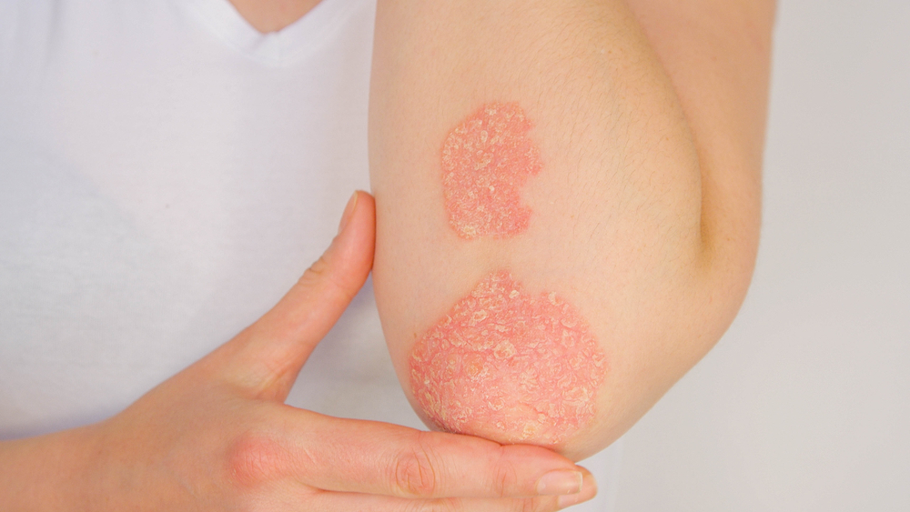 Symptoms of Psoriasis: More Than Just Dry, Scaly Skin