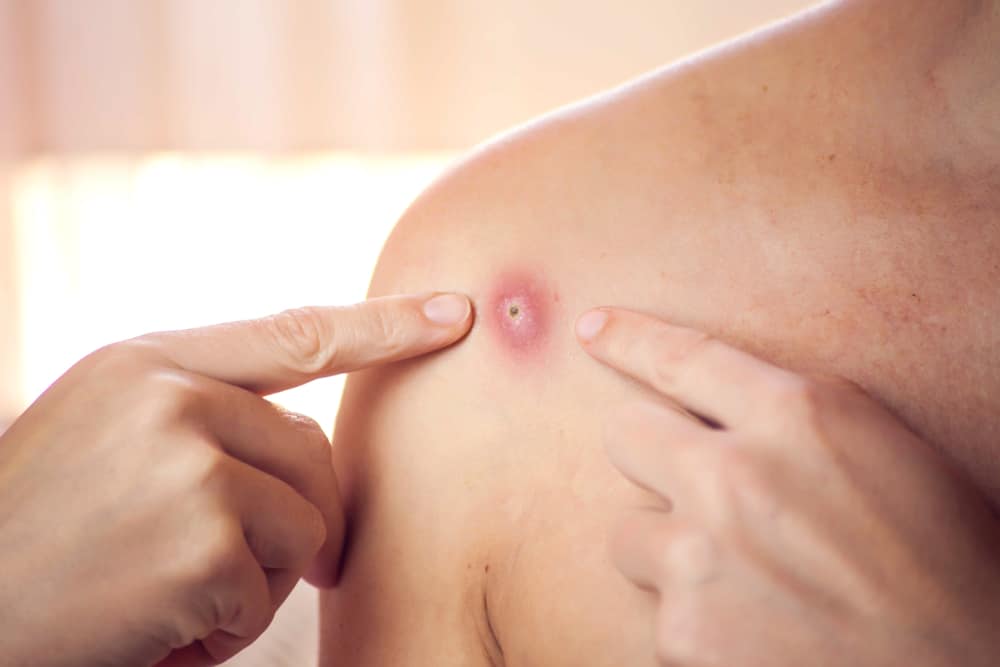 Stages of a Boil: What to Expect and What You Can Do