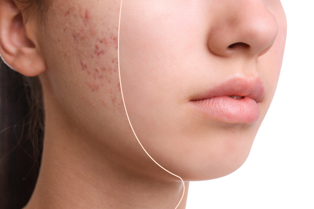 What Causes Acne: Factors That Aggravate The Skin Condition