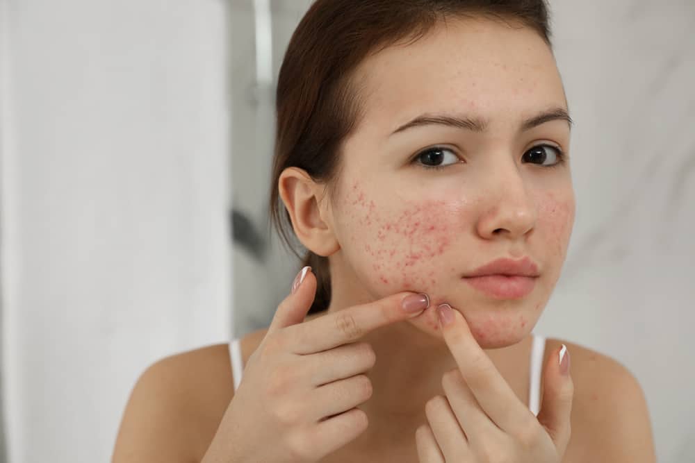 How to Prevent Acne Scars Naturally