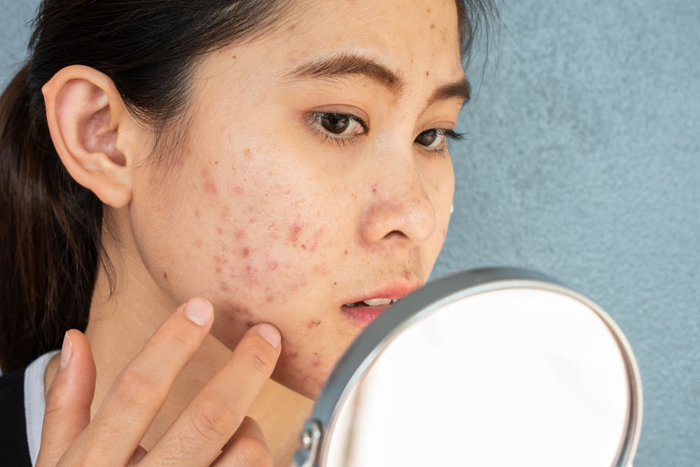How To Manage Teenage Acne: Tips To Beat Skin Breakouts