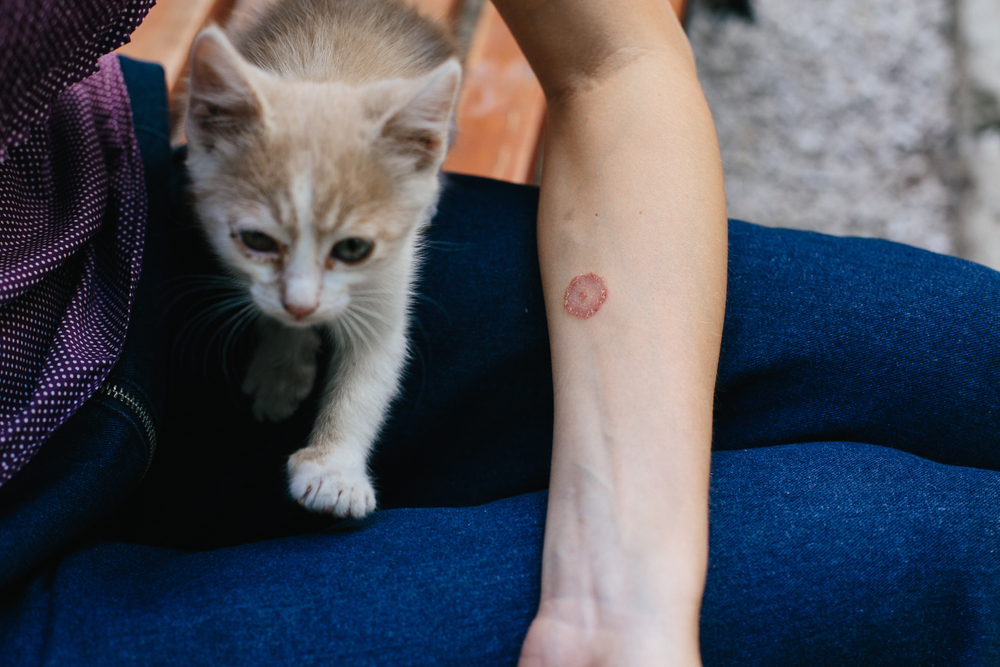Buni Causes: What You Should Know About Ringworm