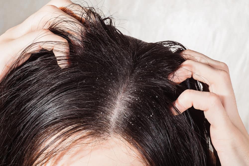 Difference Between Psoriasis and Dandruff?: What to Know