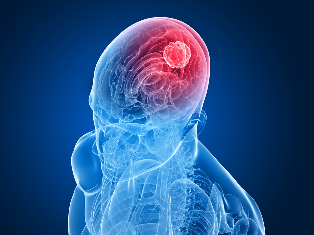 Brain Tumor Symptoms: Everything You Need to Know