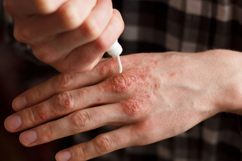 How to Prevent Psoriasis Flare-Ups: Managing the Autoimmune Disease