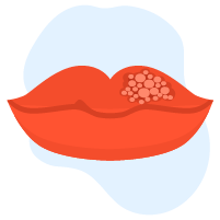 Can Herpes Lead to Cancer?