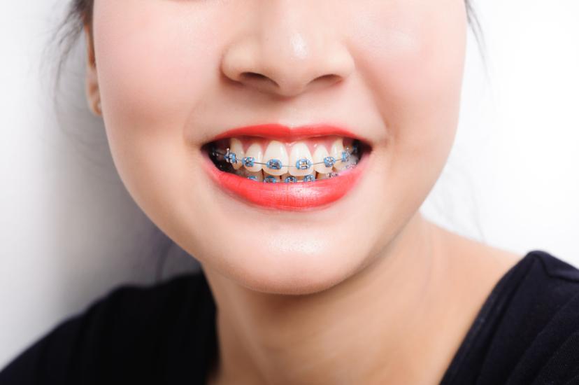 How Do Braces Move Your Teeth? Find Out the Answer Here