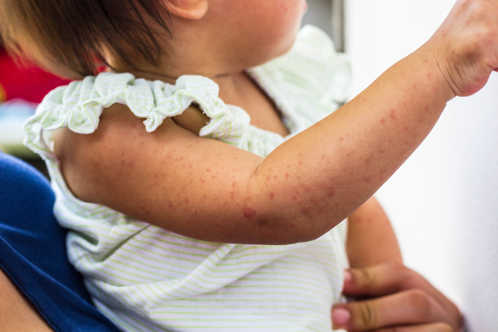 German Measles vs. Measles: Which is More Severe?