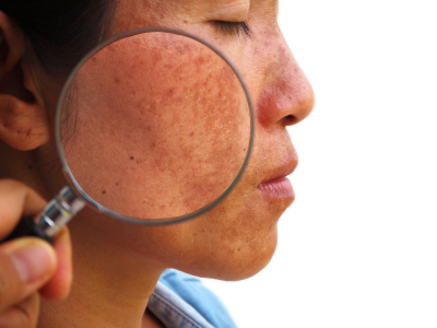 Melasma vs Hyperpigmentation: What's the Difference?