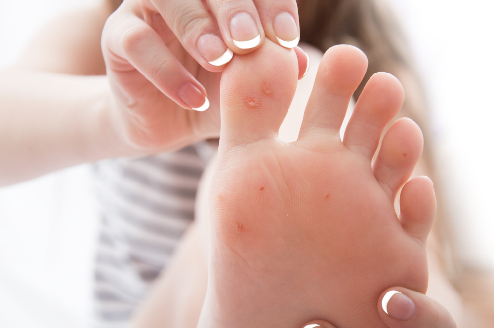 How To Remove Calluses Tips To Do It Safely and Painlessly