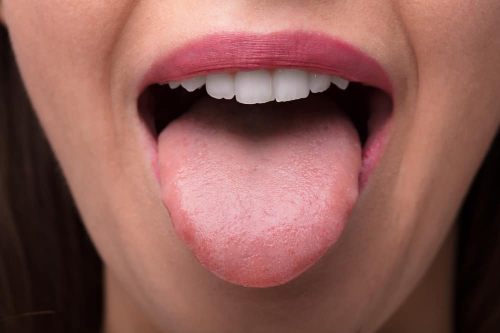 Rare Tongue Condition: Understanding Glossitis and Its Effects