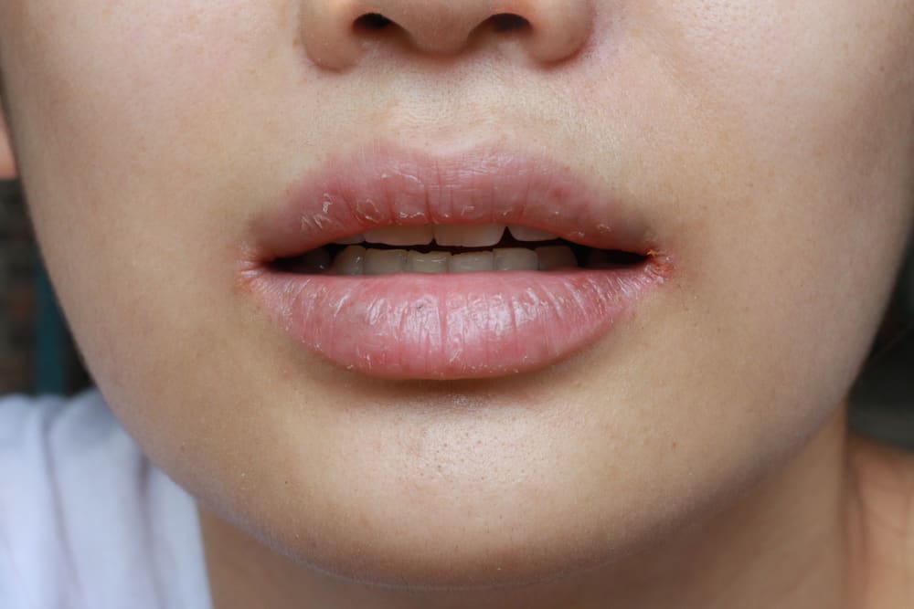Dry Mouth and Throat: All You Need to Know About Xerostomia