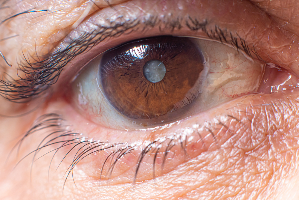 Do Cataracts Cause Blindness: What are the Causes and Risk Factors