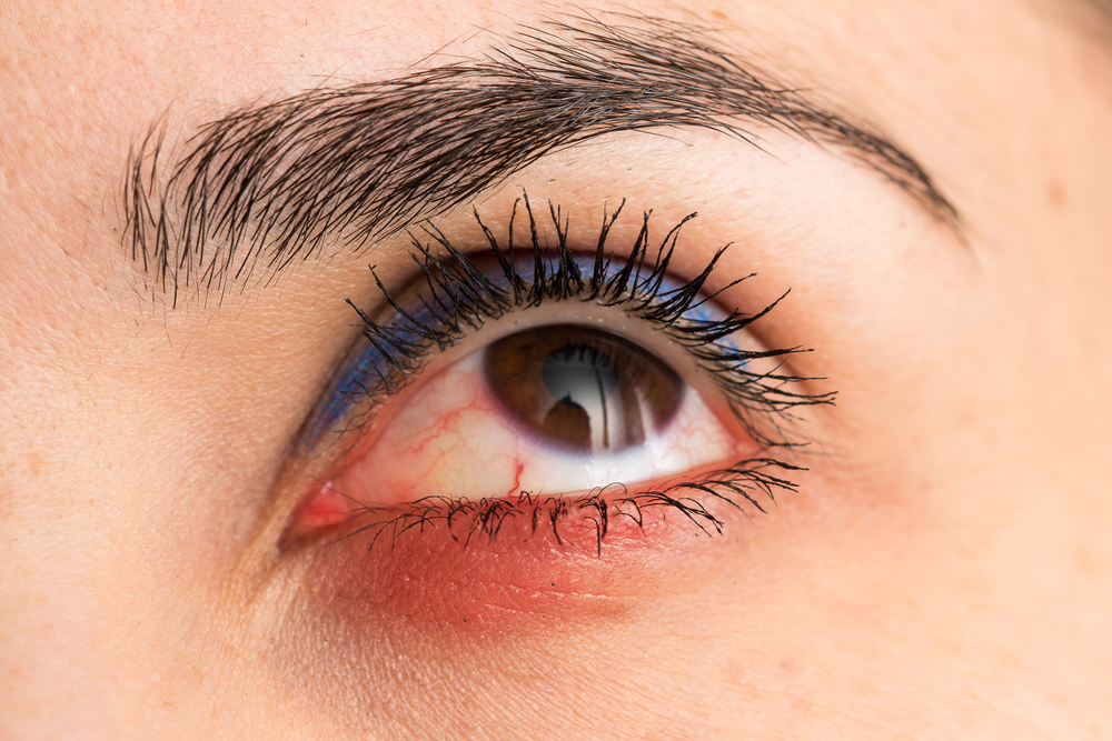 Uveitis Treatment and Diagnosis: What You Should Know