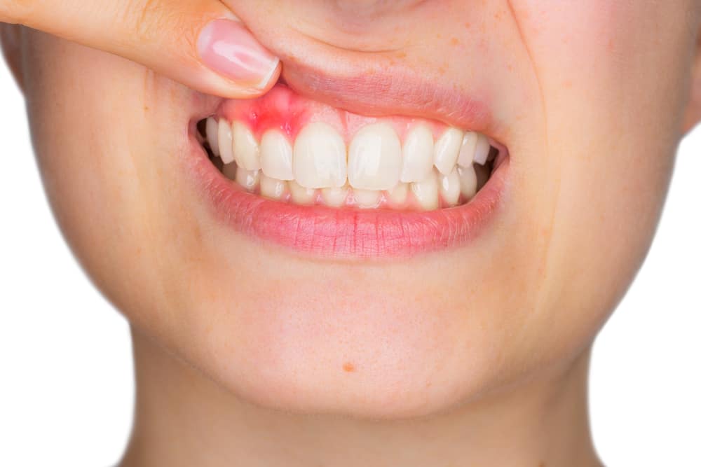 Gingivitis Causes: What's Making My Gums Bleed?