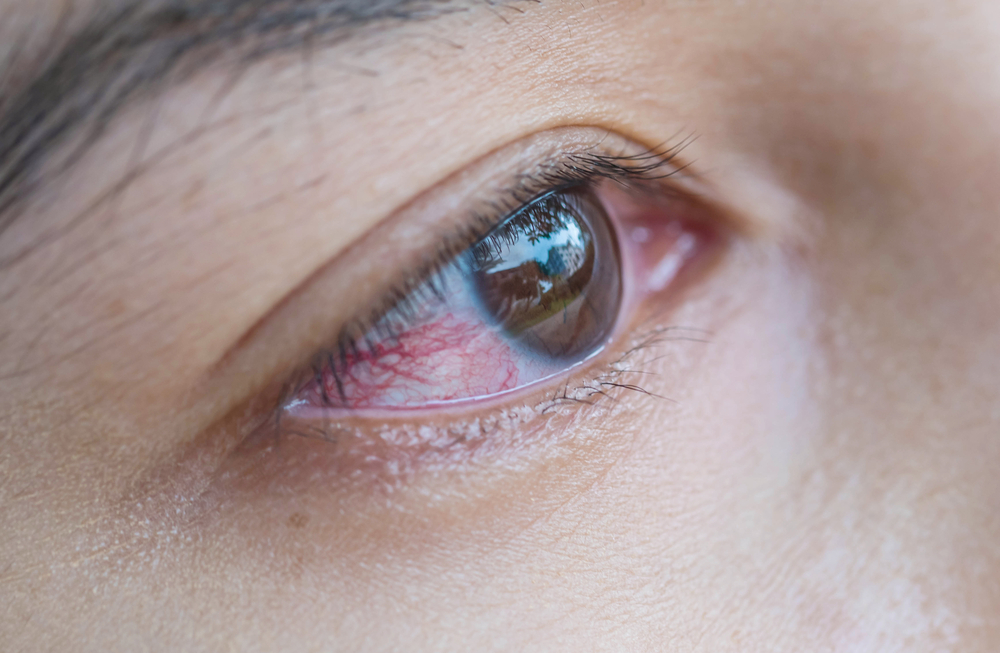 How to Prevent Eye Redness: Tips That are Worth a Try