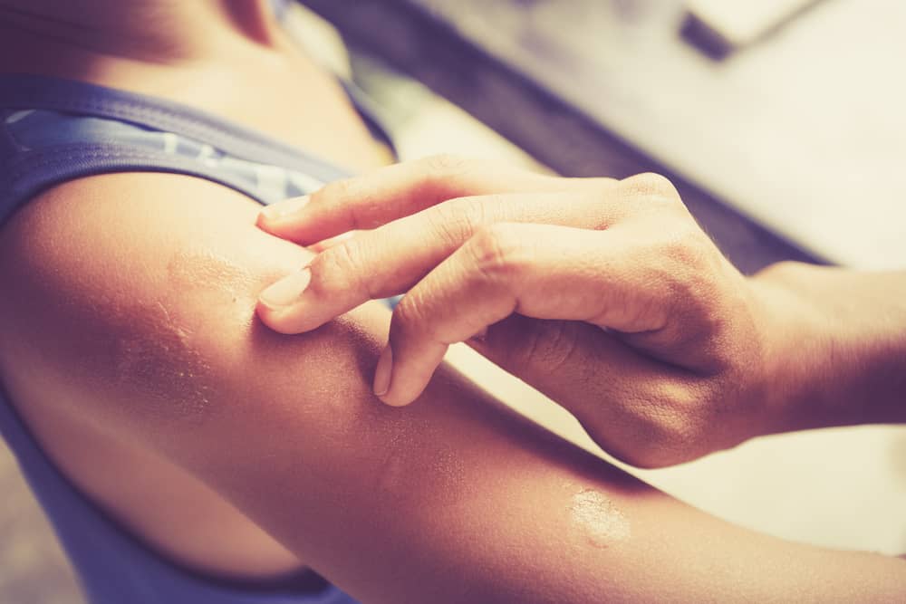 Childhood Eczema Causes and Home Remedies