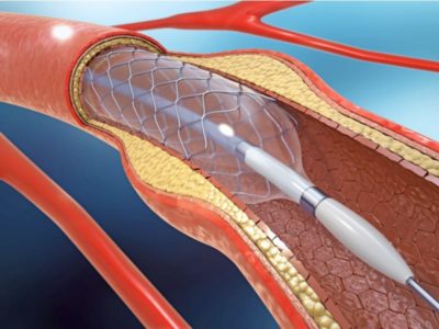 Angioplasty: What is it and How is it Done?