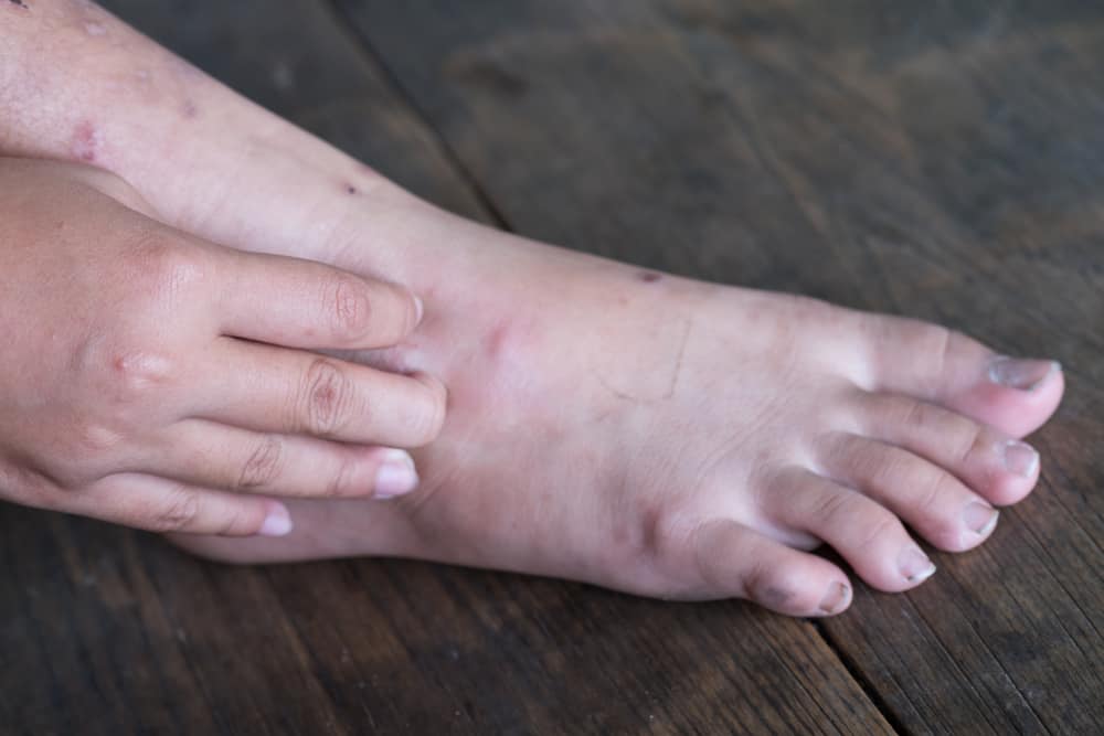 Diabetic Ulcer: Signs and Symptoms, Prevention, Treatment