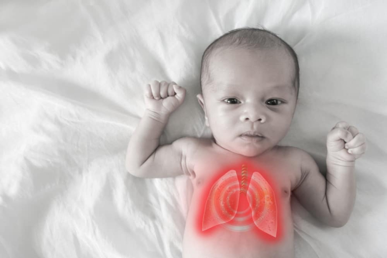 Meconium Aspiration LongTerm Effects and Treatment