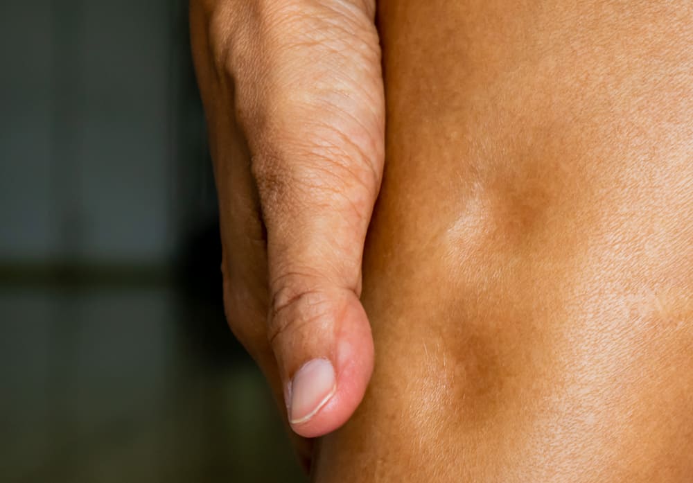 What Is Pitting Edema?