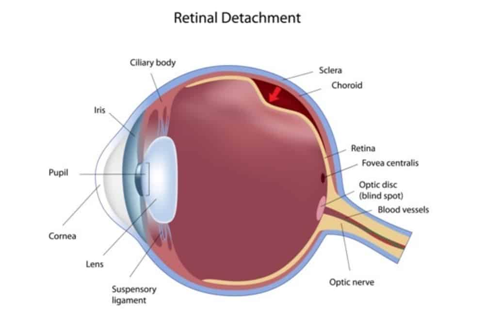 Retinal Detachment Causes and Treatment: How Does it Affect Vision?