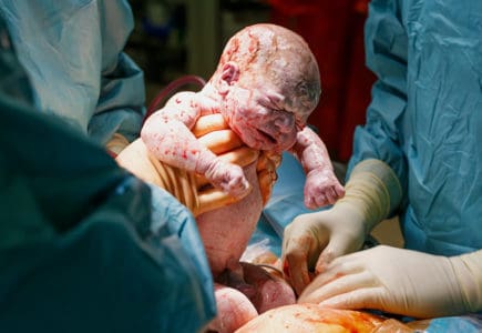 Cesarean Section: When is it Recommended During Pregnancy?