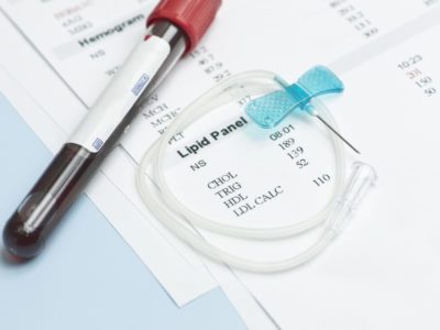 LDL Test (Low-Density Lipoprotein): Why And How Is It Done?