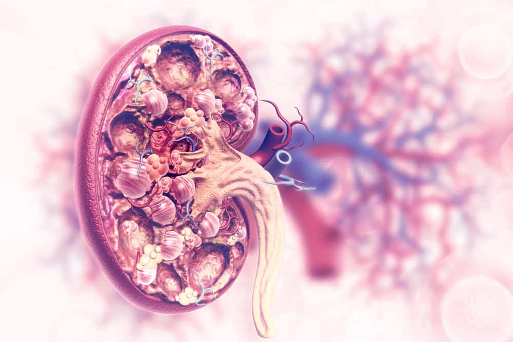 Sakit sa Kidney: 7 Most Common Kidney Disorders