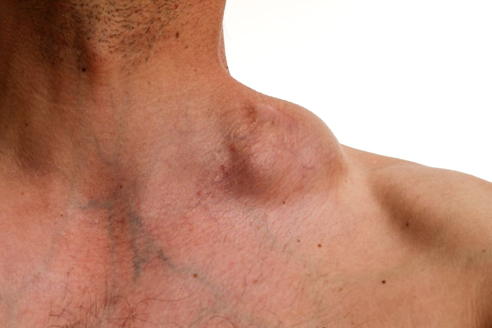 Swollen Lymph Nodes: Are They Signs Of A Serious Condition?