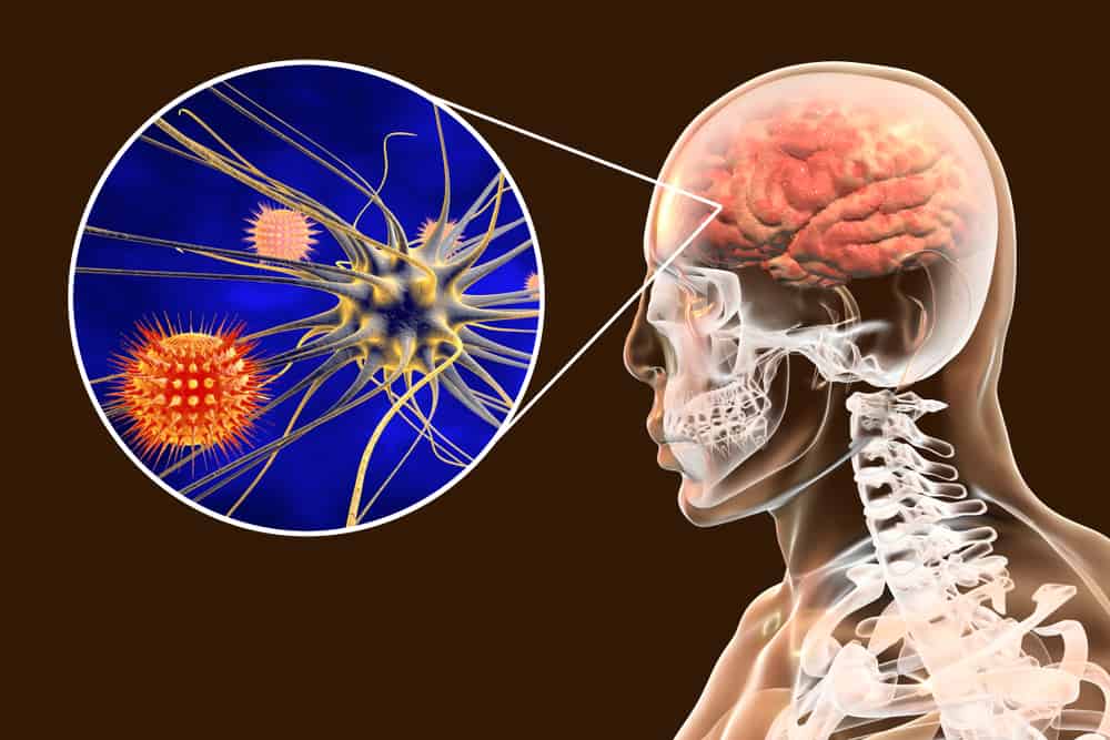 Viral Meningitis: A Quick Background On The Neurological Disease