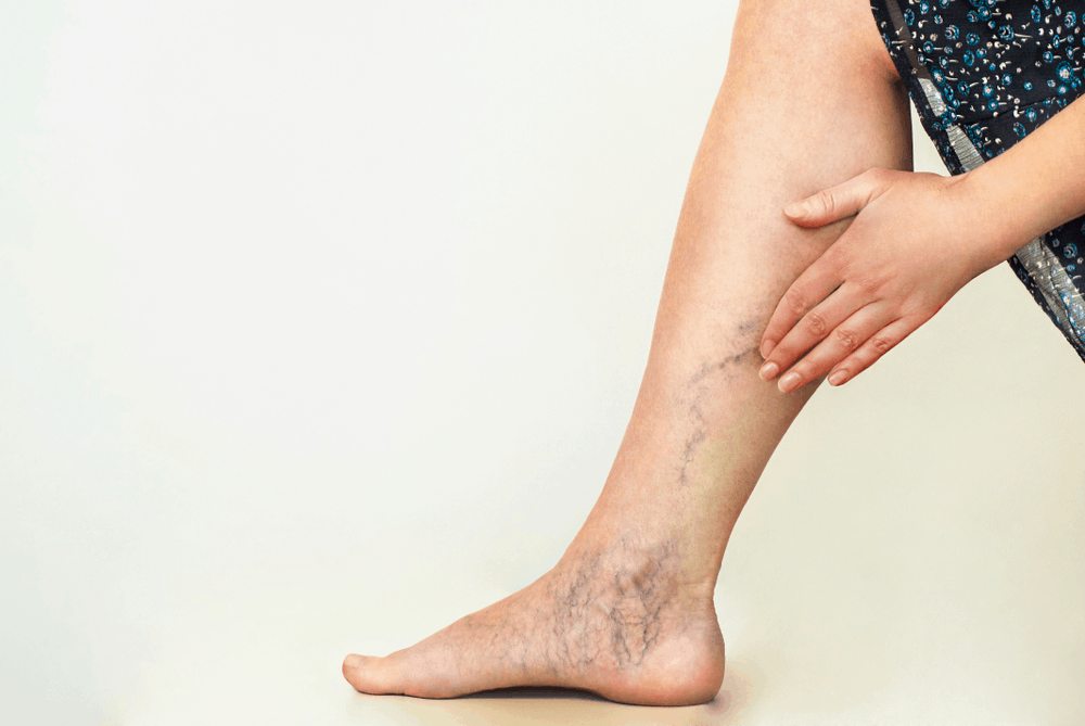 Best Treatment for Varicose Veins: Home and Surgical Options