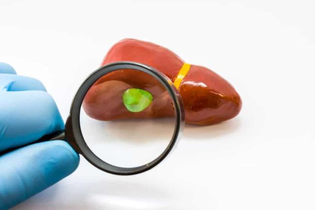 Contracted Gallbladder: Symptoms, Risks, Complications, and Treatment